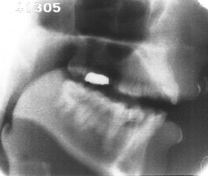 Radiographie de la voyelle [ɑ]