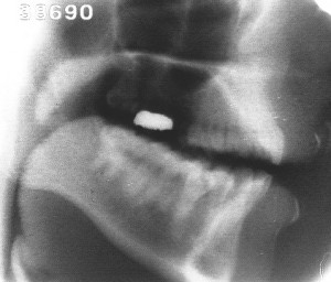 Radiographie de la voyelle [ɑ̃]