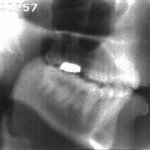 Radiographie de la consonne [d]