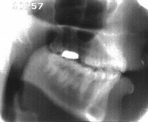 Radiographie de la consonne [d]