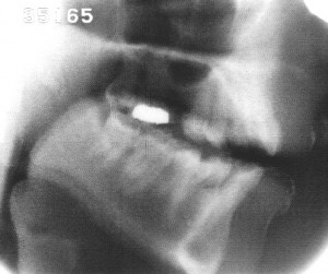 Radiographie de la voyelle [a]