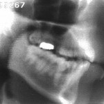 Radiographie de la consonne [b]