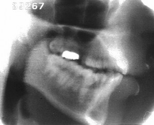 Radiographie de la consonne [b]