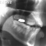 Radiographie de la consonne [ʃ]