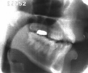 Radiographie de la consonne [ʃ]