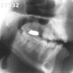 Radiographie de la voyelle [e]