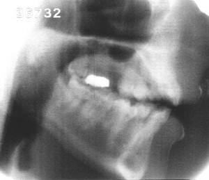 Radiographie de la voyelle [e]