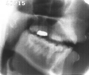 Radiographie de la voyelle [ɛ]