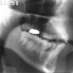 Radiographie de la consonne [f]