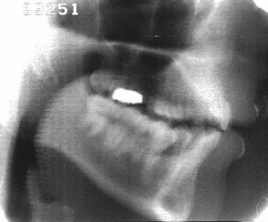 Radiographie de la consonne [f]