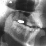 Radiographie de la consonne [g]