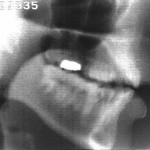 Radiographie de la consonne [ʒ]