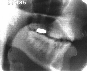 Radiographie de la consonne [ʒ]