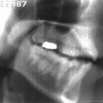 Radiographie de la consonne [ɲ]