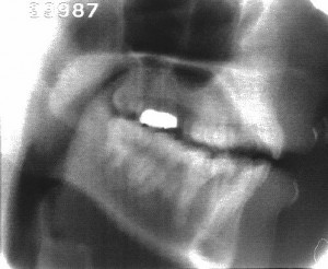 Radiographie de la consonne [ɲ]