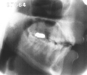 Radiographie de la voyelle [i]