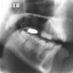 Radiographie de la voyelle nasale [ɛ̃]