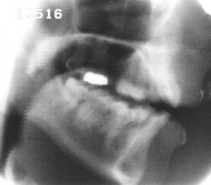 Radiographie de la voyelle nasale [ɛ̃]