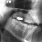 Radiographie de la glide [j]