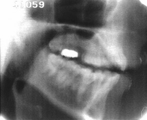 Radiographie de la glide [j]