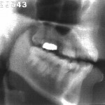 Radiographie de la consonne [k]