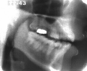 Radiographie de la consonne [k]