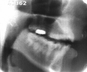 Radiographie de la consonne [l]