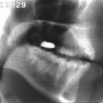 Radiographie de la consonne [m]