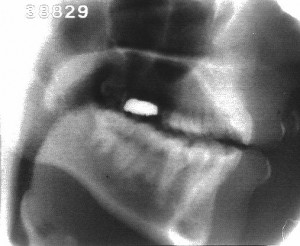 Radiographie de la consonne [m]