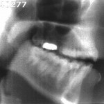 Radiographie de la consonne [n]