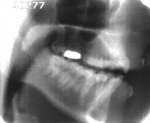 Radiographie de la consonne [n]