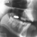 Radiographie de la voyelle [ɔ]