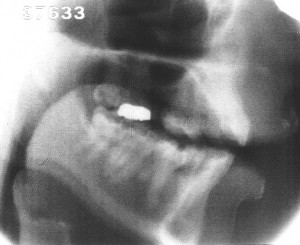 Radiographie de la voyelle [ɔ]