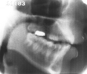 Radiographie de la voyelle [o]