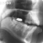 Radiographie de la voyelle nasale [ɔ̃]