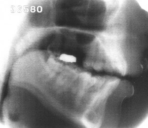 Radiographie de la voyelle nasale [ɔ̃]