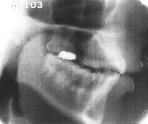 Radiographie de la voyelle [u]