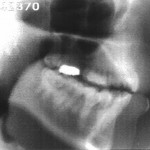 Radiographie de la consonne [p]