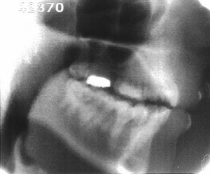 Radiographie de la consonne [p]