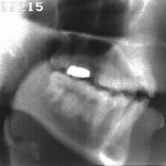 Radiographie de la consonne [s]