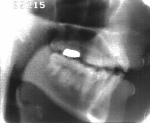 Radiographie de la consonne [s]