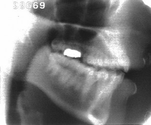 Radiographie de la consonne [t]