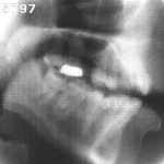 Radiographie de la voyelle nasale [œ̃]