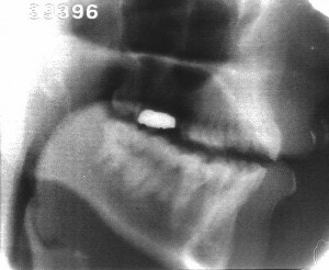 Radiographie de la consonne [v]