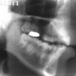 Radiographie de la glide [w]