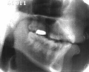 Radiographie de la glide [w]