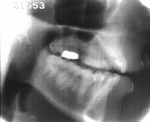 Radiographie de la glide [ɥ]