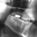 Radiographie de la consonne [z]